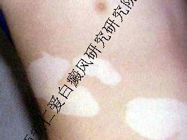 白癜风心理治疗有哪些 白癜风心理治疗有哪些