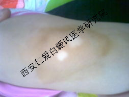 诊断白癜风的方法有哪些 诊断白癜风的方法有哪些